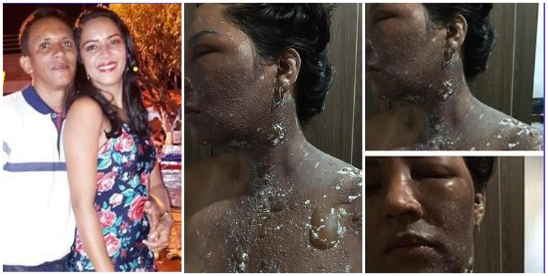 Ex-vereador descobre traição e joga água quente no rosto da esposa vereadora no Maranhão
